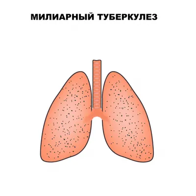 Может ли туберкулез пройти сам по себе - первичное и вторичное  инфицирование и профилактика заболевания