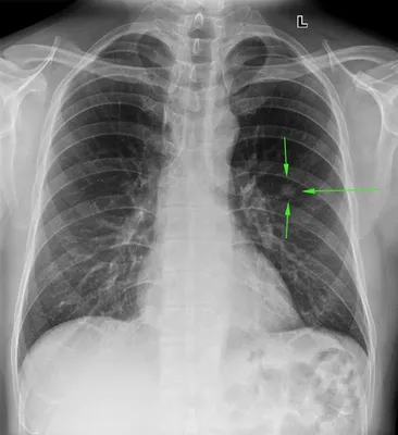 Из жизни рентгенолога. Часть 7. Туберкулезный ликбез. | Пикабу