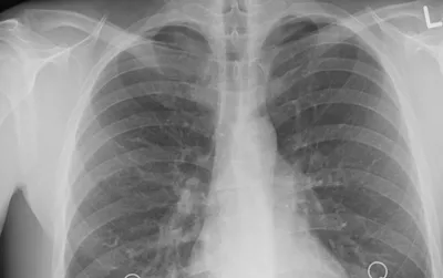 Рентгеновский снимок по фтизиатрии | Пикабу