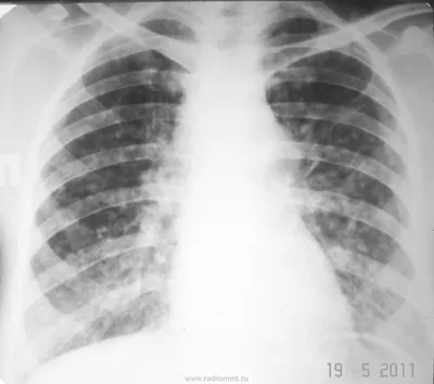 Image: Милиарный туберкулез - Справочник MSD Профессиональная версия
