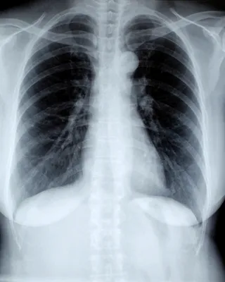 Туберкулез или затяжная пневмония? | Портал радиологов