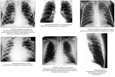 Туберкулез отступает: в Грузии сократились случаи заболевания