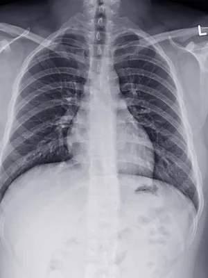 Туберкулёз Легких Правом Верхнем Лёгком стоковое фото ©YAY_Images 617985144