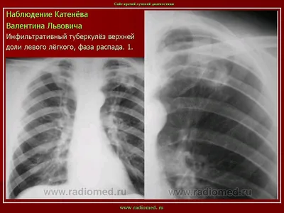 Инфильтративный туберкулез легких - фазы, причины, формы, симптомы,  диагностика, лечение, прогноз