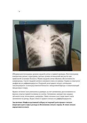 Инфильтративный туберкулез легких: скиалогическая картина, принципы