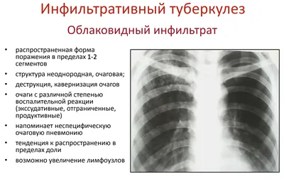 Туберкулез: что таит в себе данное заболевание - Klinik.by