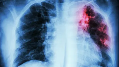 Виды туберкулеза на рентгене - YouTube