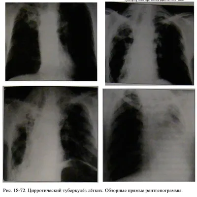 Туберкулёз. Инфильтративный туберкулёз. + | Портал радиологов