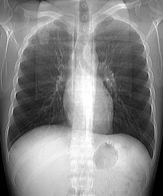 Фиброзно-кавернозный туберкулёз... - tbc_and_lung_diseases | Facebook