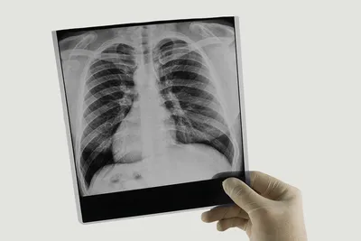 Рентген Грудной Клетки Показаны Advanced Туберкулез Легких — стоковые  фотографии и другие картинки Pneumonitis - iStock
