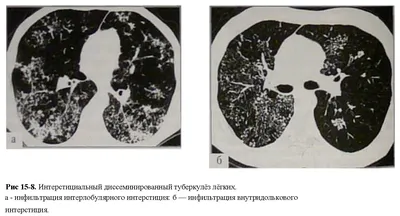 Легочный туберкулез (TB): Инфильтрат выставки рентгена грудной клетки  луночный на обоих легкий должное к инфекции туберкулеза мик Стоковое  Изображение - изображение насчитывающей воображение, здоровье: 54064509