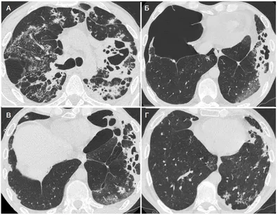 Туберкулез легких | Радиография