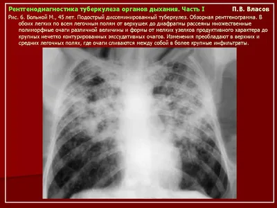 Туберкулёз: Лучевая диагностика | ТБ Инфо