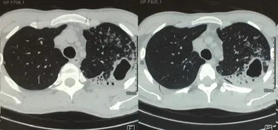 Легочный туберкулез (рентген грудной клетки фильма: Interstitial  инфильтрирует оба легкего должное к инфекции туберкулеза микобак Стоковое  Фото - изображение насчитывающей медицинско, внимательность: 63290156