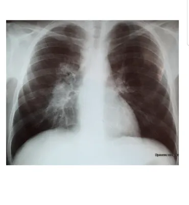 Файл:Chest plain film. Fibrotic cavitary Tuberculosis.jpg — Википедия