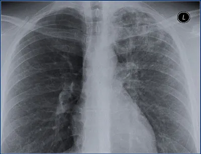 строгий туберкулез стоковое фото. изображение насчитывающей фиброз -  155299388