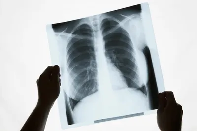 Как выглядит туберкулез легких на КТ - диагностика разных форм заболевания
