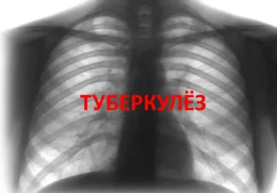 Инфекция туберкулёза микобактерий (туберкулёз легких) ) стоковое фото  ©stockdevil_666 61211873