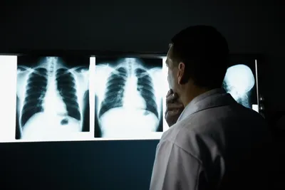 Туберкулез плевры | Радиография