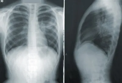 туберкулез легких здоровье рентген туберкулез Фото Фон И картинка для  бесплатной загрузки - Pngtree