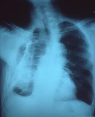 Как выглядят легкие здорового человека на рентгене