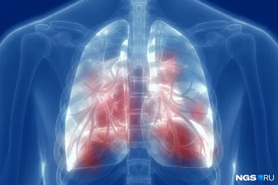 Туберкулёз. Диссеминированный туберкулёз. Диагностика и дифференциальная  диагностика гематогенно-диссеминированного туберкулеза легких. + | Портал  радиологов