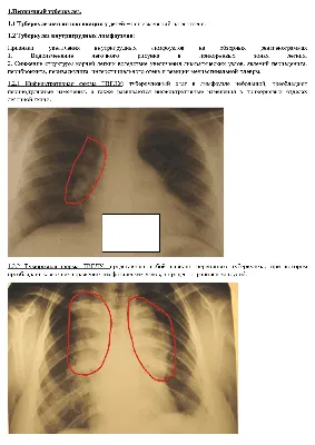 Особенности рентгенодиагностики туберкулеза в зависимости от локализации в  легких | Медицинские интернет-конференции
