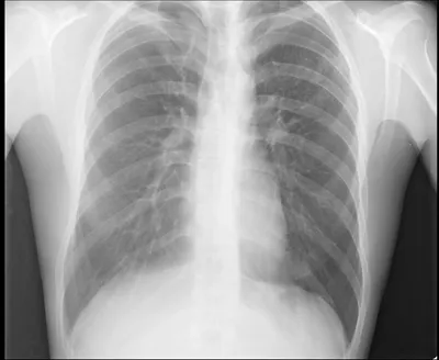 Туберкулез: легких, кожи, костей, пр; симптомы и лечение