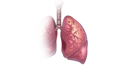 Туберкулез легких: симптомы и первые признаки, лечение