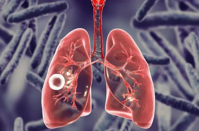 Инфильтративный туберкулез легких - фазы, причины, формы, симптомы,  диагностика, лечение, прогноз