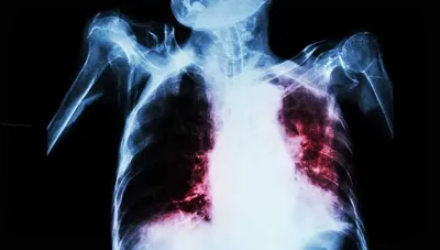 Как распознать симптомы туберкулеза и что делать, если вы испытываете  опасения