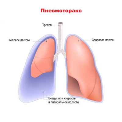 Туберкулез легких - причины появления, симптомы заболевания, диагностика и  способы лечения