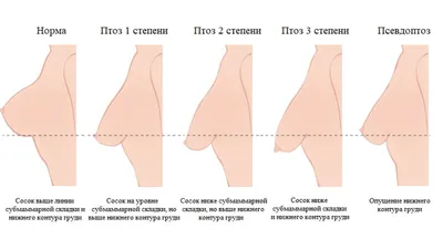 Двойная складка после маммопластики: причины возникновения, как исправить