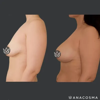Что такое тубулярная грудь и методы коррекции – ANACOSMA Тубулярная грудь:  что это и как исправить