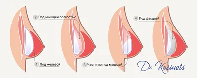 Маммопластика (пластика груди) - цены, фото до и после операции, отзывы.  Стоимость операции по пластике груди - клиника Beauty Trend