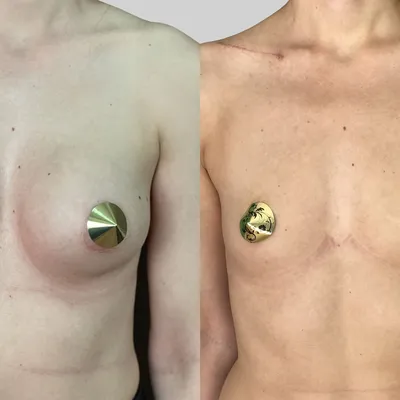 Тубулярная форма груди