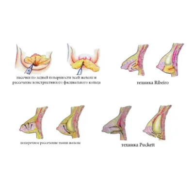 Коррекция тубулярной груди в Киеве - Хирург Бебих