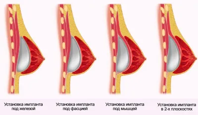Пластика тубулярной груди в Москве - Damas Medical Center