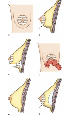 Грудные импланты: виды, размеры, формы и сколько стоят – Mammaclinic