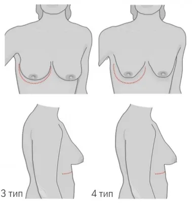 Виды тубулярной деформации груди | Александр Маркушин пластический хирург
