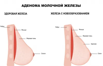 Какой вид доступа лучше при увеличивающей маммопластике? | Блог клиники  «DEGA»