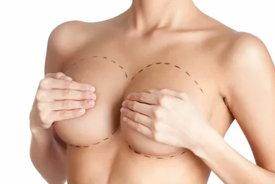 Коррекция асимметрии груди, пластика тубулярной груди в Киеве | SLOSSER
