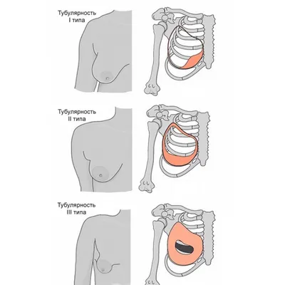 Пластика тубулярной груди в Москве - Damas Medical Center