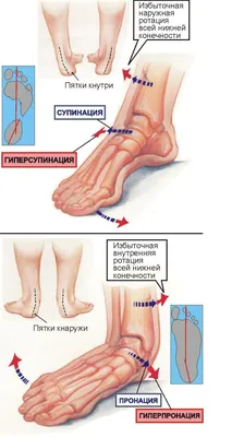 Почему болит стопа с внешней стороны? | медицинские товары и медтехника в  магазине Ортосалон