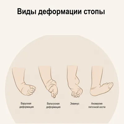Все, что нужно знать бегуну об избыточной пронации (гиперпронации)