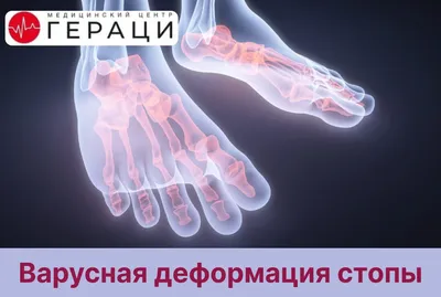 Варусная деформация стоп — причины, советы ортопеда, лечение