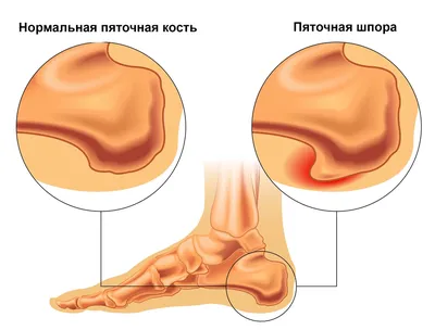 Гиперпронация стопы: это отклонение? I блог Olvi.ua - Статьи сайта -  полезная информация