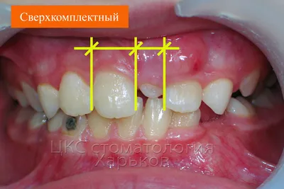 Щербинка у ребенка: как убрать щель между зубами в детском возрасте? - SHiFA