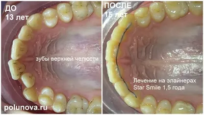 Как сохранить передние молочные зубы