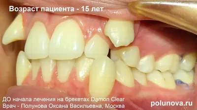 Молочные и коренные зубы у ребёнка: особенности роста и смены –  стоматология ПрезиДЕНТ